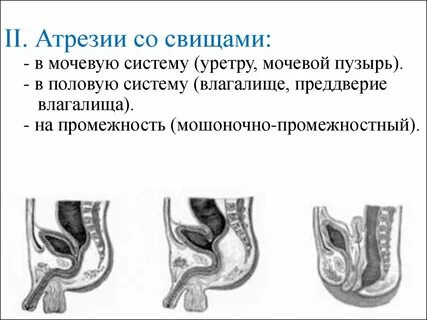 Влагалищный свищ