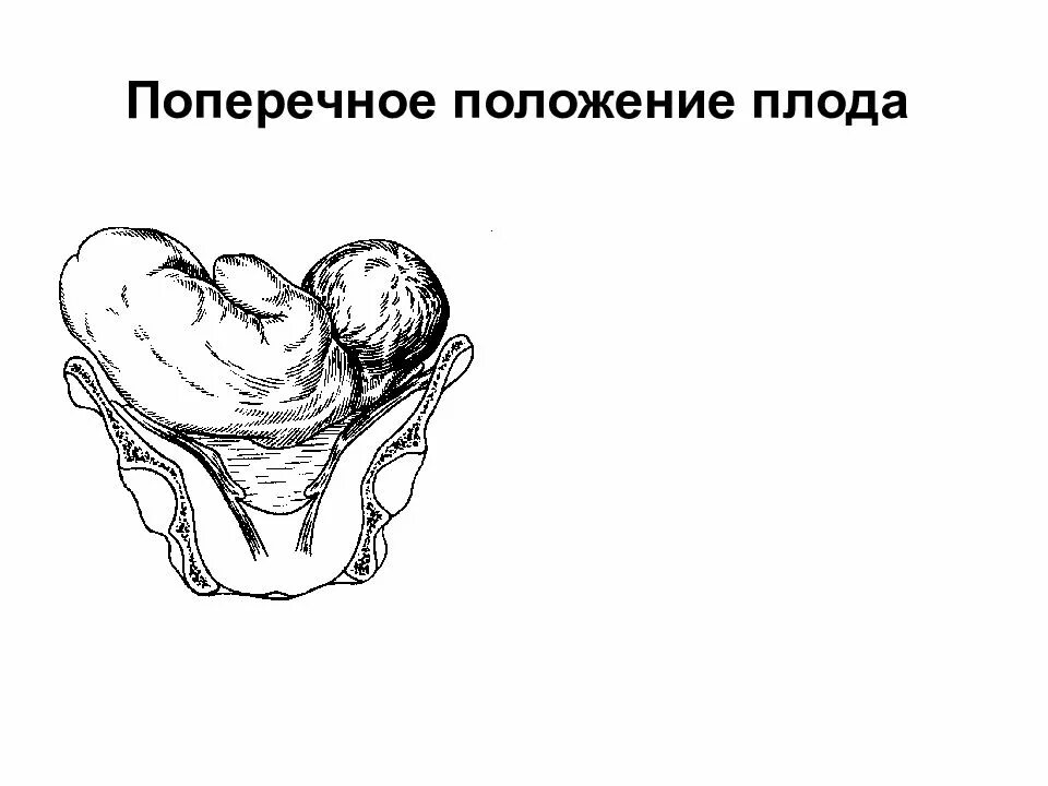 Положение плода акушерское. Продольное поперечное косое положение плода. Поперечное положение плода в 29 недель беременности. Продольное головное предлежание плода. Продольная ось плода и продольная ось матки.