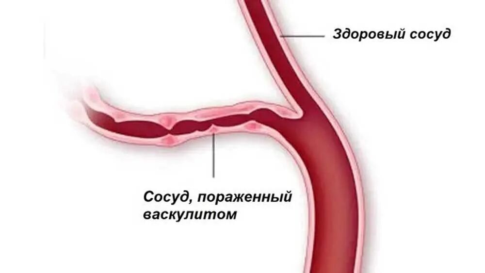 Узелковый некротический васкулит. Первичные системные васкулиты. Системные васкулиты клинические