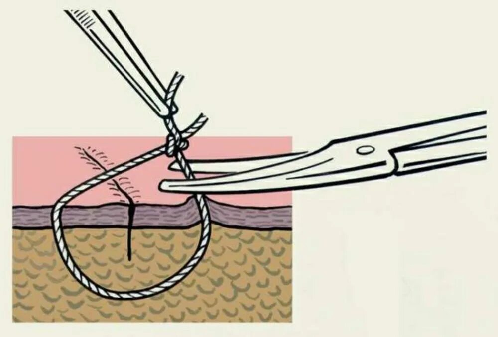 Шов через нитку. Техника снятия узловых швов. Технология снятия послеоперационных швов. Техника снятия швов с раны.