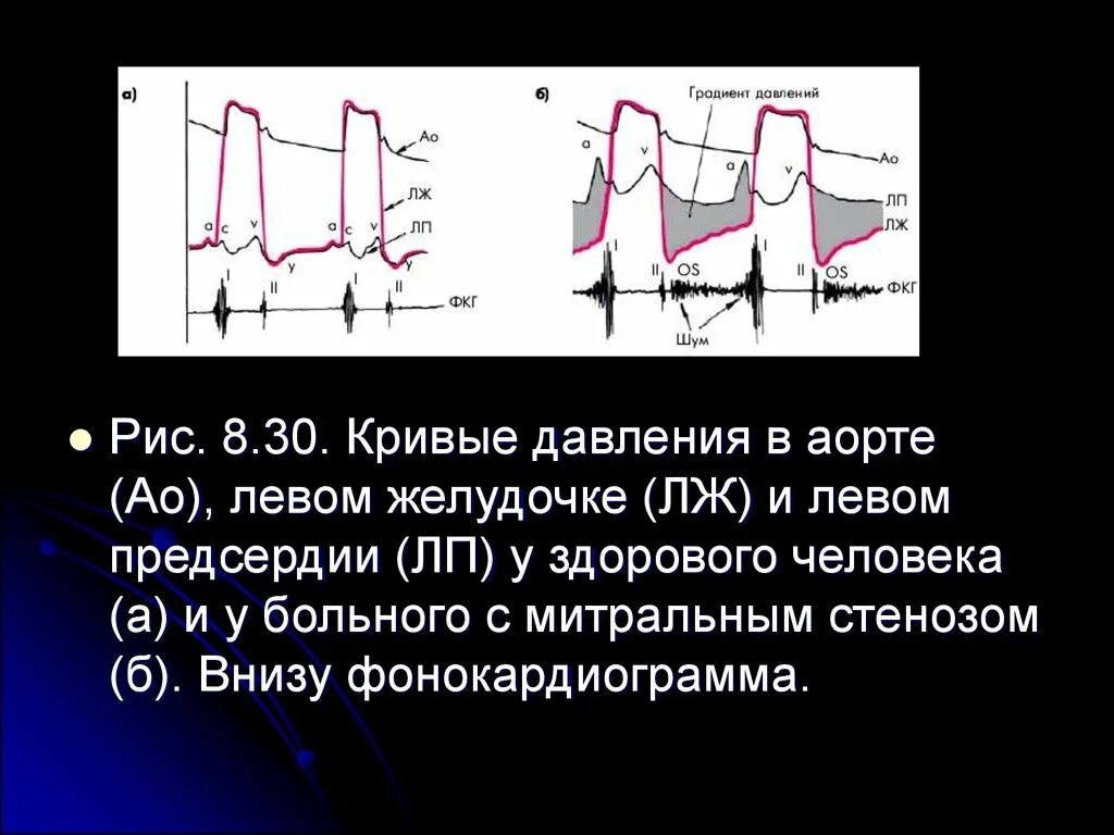 Давление в правом предсердии. Градиент давления на аортальном клапане. Градиент давления на аортальном клапане норма. Кривые давления в предсердиях. Нормы градиентов давления на клапанах сердца.