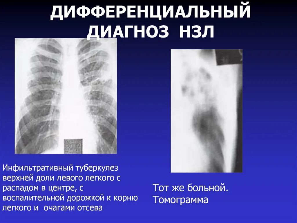 Без очаговых и инфильтративных изменений. Инфильтративный туберкулез на кт. Инфильтративный туберкулез рентген. Инфильтративный туберкулез легкого. Инфильтративный туберкулез верхней доли левого легкого.