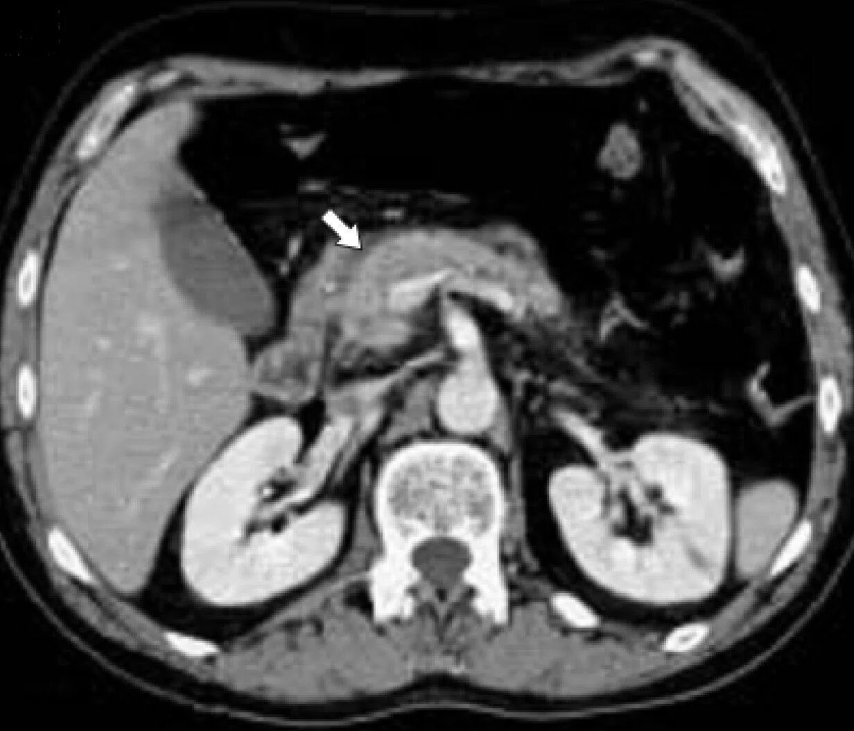 панкреонекроз поджелудочной железы кт. кальцинаты поджелудочной железы кт. острый некротический панкреатит кт. деструктивный панкреатит кт. хронический панкреатит кт.