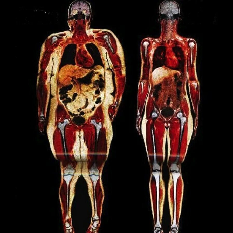 Люди с широкими костями. Внутренние органы человека с ожирением.