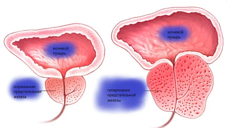 Аденома (гиперплазия) предстательной железы патогенез. Секреторная функция предстательной железы. Аденома предстательной железы этиология. Доброкачественная гиперплазия предстательной железы (ДГПЖ). Простатита гиперплазии предстательной железы