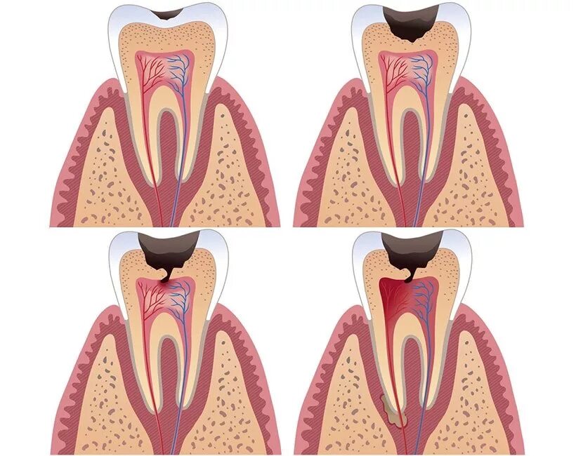 Расширение каналов зубов. Пульпит - воспаление пульпы зуба. Острый очаговый пульпит. 4 Канальный пульпит зуба.