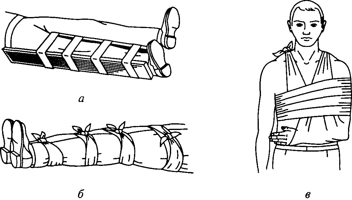 Шина при травме головы. Иммобилизация конечности при переломе голени. Шинирование при переломах конечностей. Транспортная иммобилизация при переломе верхней конечности и нижней. Транспортная иммобилизация при переломах костей верхней конечности.