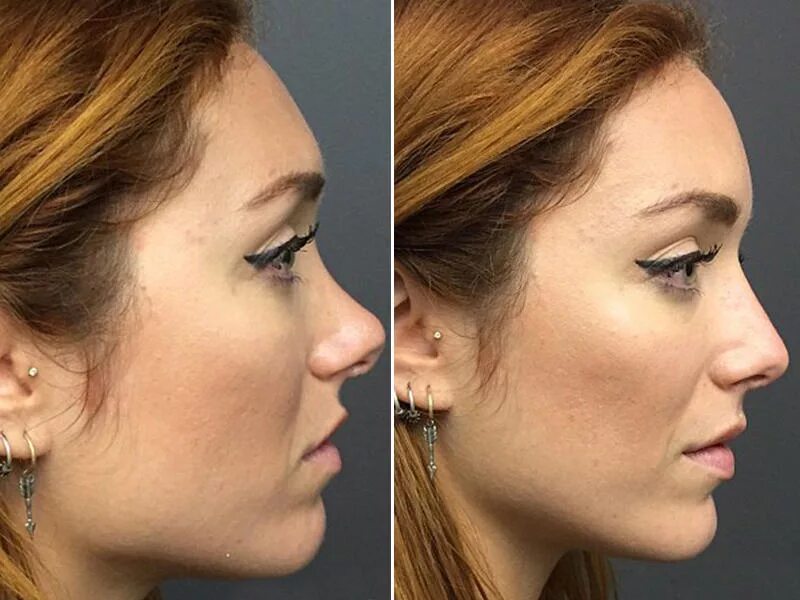 самый распространенный нос. самый распространенный нос. формы носа. формы носа. пенелопа крус нос с горбинкой.