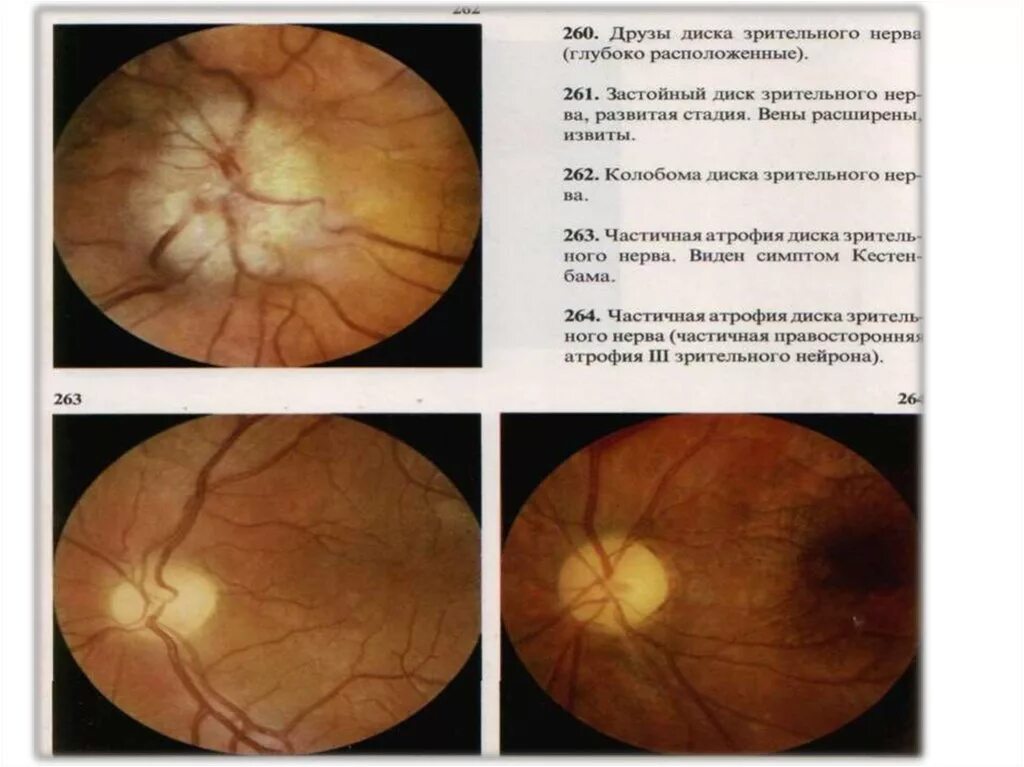 Друзы зрительного нерва на окт. Серый диск зрительного нерва. Колобома зрительного нерва. Гамартома диска зрительного нерва.