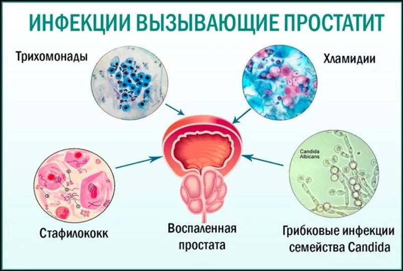 Хламидии это. Инфекции вызывающие простатит. Простатит этиология. Хронический бактериальный простатит. Простатит патогенез.