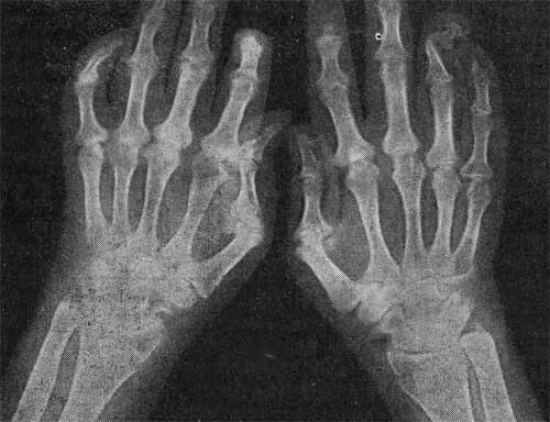 Синдром зудека лечение. Псориатический артрит на рентгенограмме. Псориатический артрит рентген. Мутилирующий псориатический артрит.