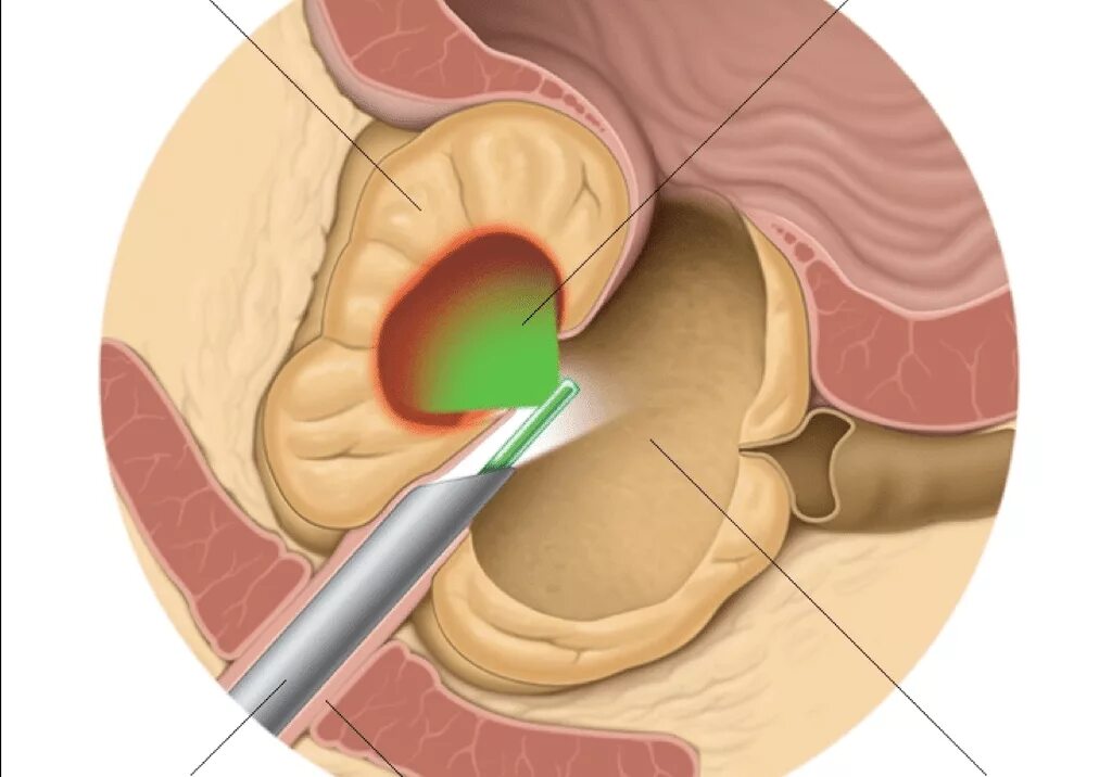 Простату телефон. Трансуретральная электрорезекция. Трансуретральная резекция мочевого пузыря. Трансуретральная резекция аденомы. Лазерная вапоризация предстательной железы.