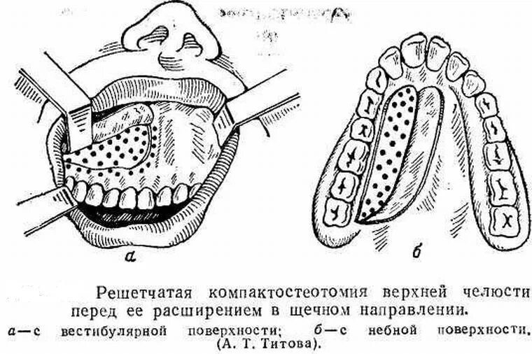 Подвижное соединение челюстей. Компактостеотомия при остеомиелите. Компактостеотомия (а. т. Титова). Линейная компактостеотомия (а.т. Титова, 1975). Ленточная компактостеотомия.