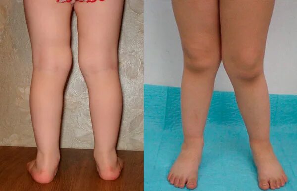 Деформация коленного сустава у детей. Вальгус деформация коленных суставов. Вальгус и х-образные ноги у ребенка. Варусная деформация коленных суставов. Вальгусная и варусная деформация стопы.