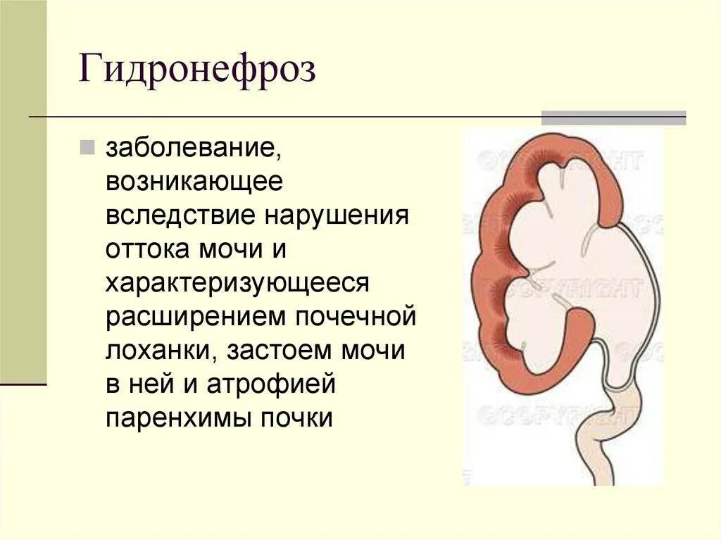 Исход заболеваний почек. Почка воспаление гидронефроз. Гидронефроз почек этиология. Гидронефроз 1ст левой почки. Расширение лоханки гидронефроз.