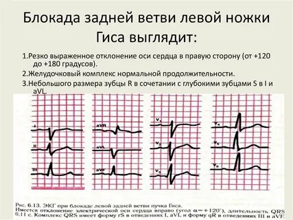 Экг признаки блокада пучка гиса