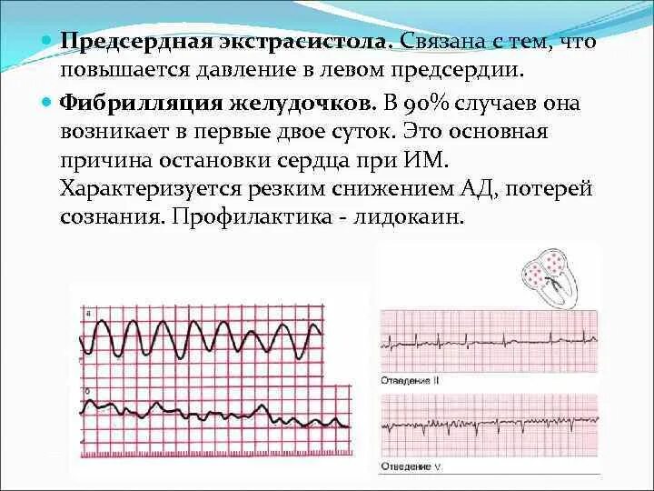 Фибрилляция желудочков на ЭКГ. Фибрилляция желудочков и инфаркт ЭКГ. Ад при фибрилляции желудочков. Фибрилляция предсердий и желудочковая экстрасистолия. Экстрасистолы у женщин