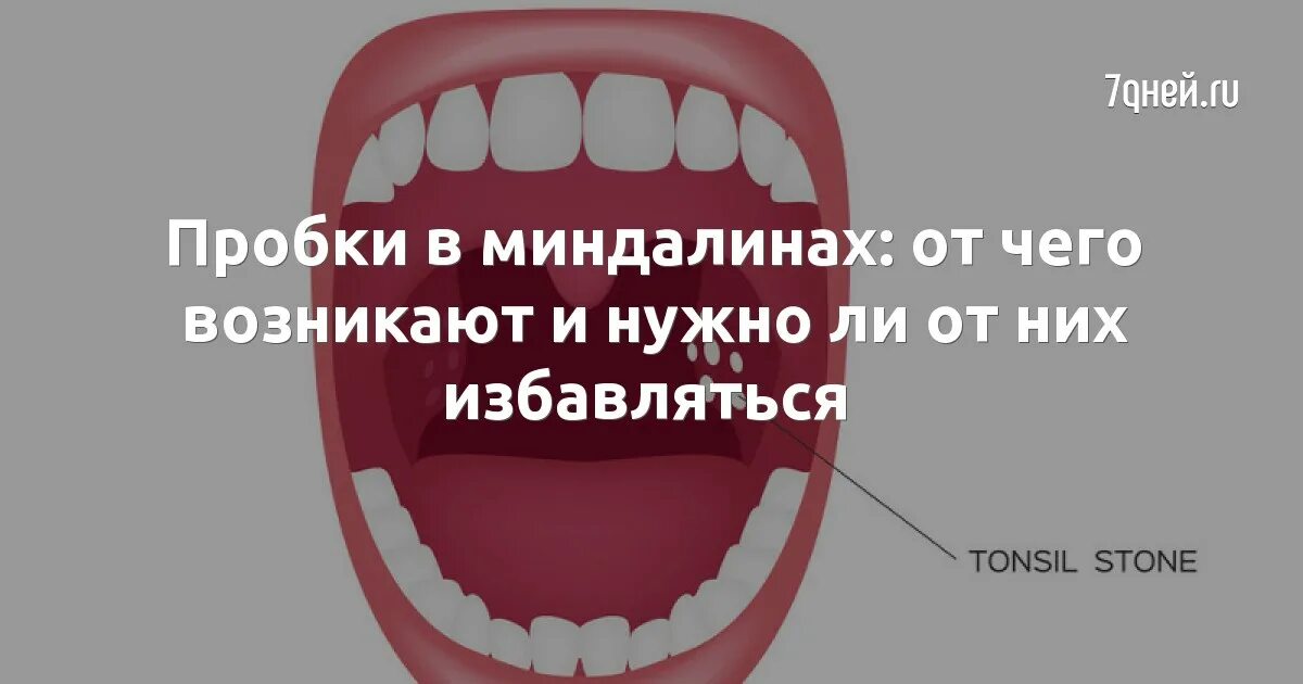 Почему появляются пробки. Пробки в небных миндалинах. Промыть пробки в миндалинах. Гнойные пробки в миндалинах.