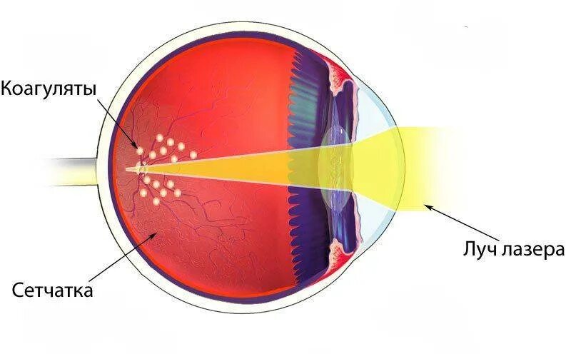 Барьерная лазеркоагуляция сетчатки. Барьерная лазерная коагуляция сетчатки глаза. Отслойка сетчатки лазеркоагуляция. Панретинальная лазерная коагуляция. Диаметр сетчатки