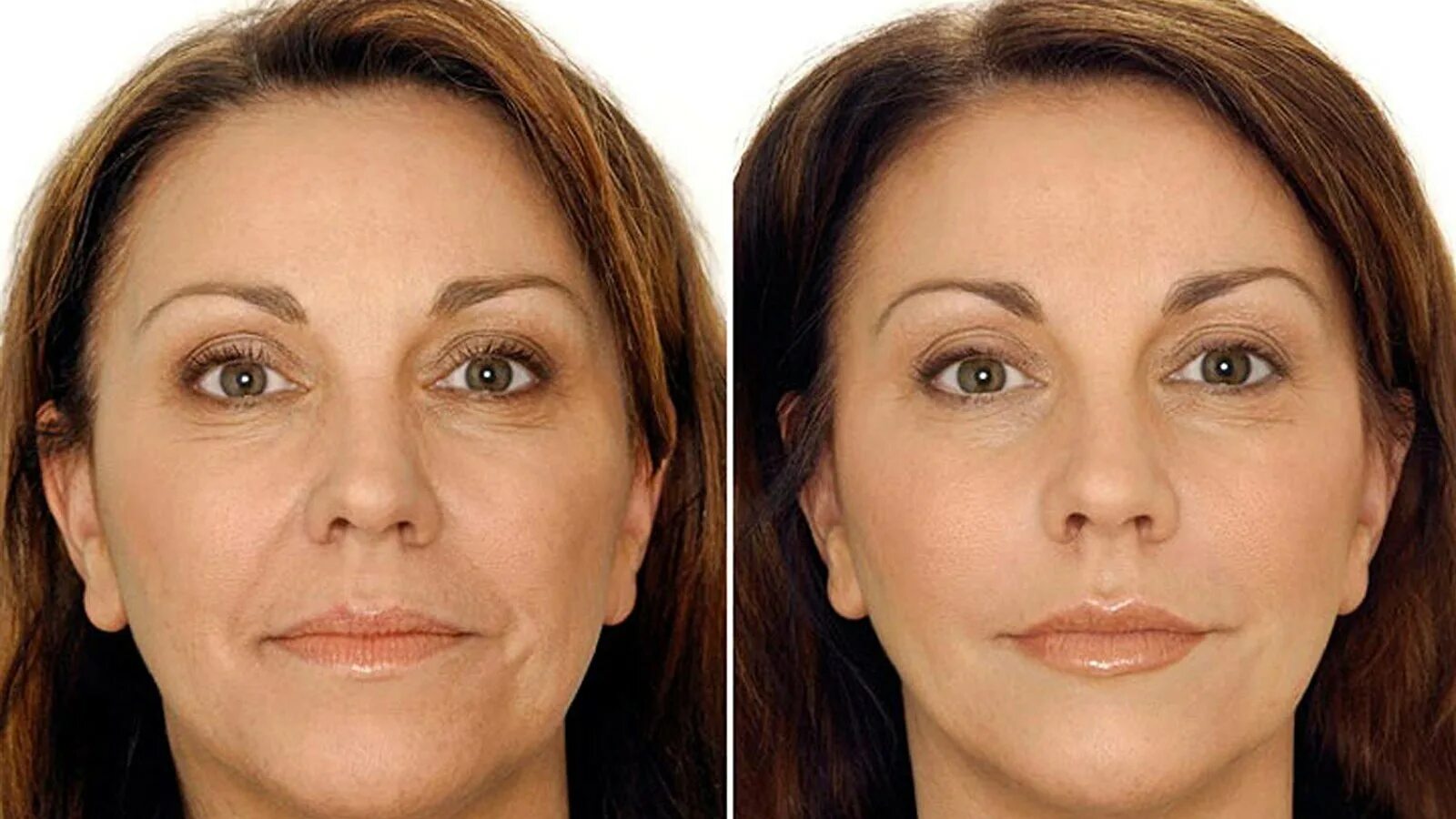 Cheek Lift фото до и после. Фотостарение лица. Рестилайн носогубные складки. Коррекция возрастных изменений