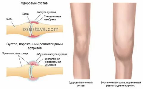 Артропатия суставов у детей