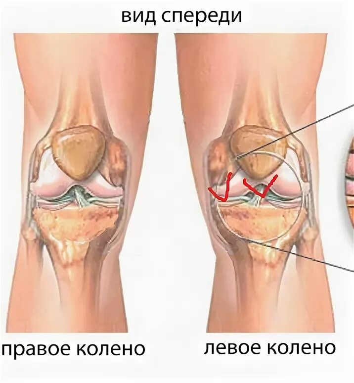 Боль под коленом спереди. Строение колена болит сбоку. Крестовидные связки коленного сустава анатомия. Крестообразные связки колена анатомия. Строение колена человека и боли в колене с наружной стороны сбоку.