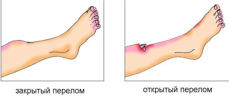 Закрытые и открытые повреждения. Открытый и закрытый перелом рисунок. Открытые и закрытые передома. Открытые и закрытые переломы. Открытый перелом и закрытый перелом.