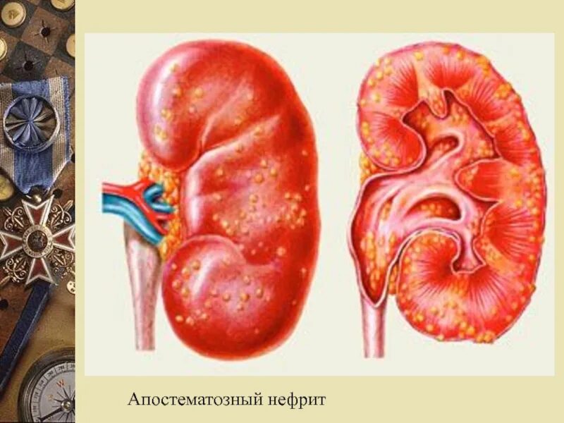 1 острый пиелонефрит. Полинифрит почек хронический пиелонефрит. Болезни почек нефриты нефрозы. Хронический и острый нефрит, ХПН;. Апостематозный пиелонефрит макропрепарат.