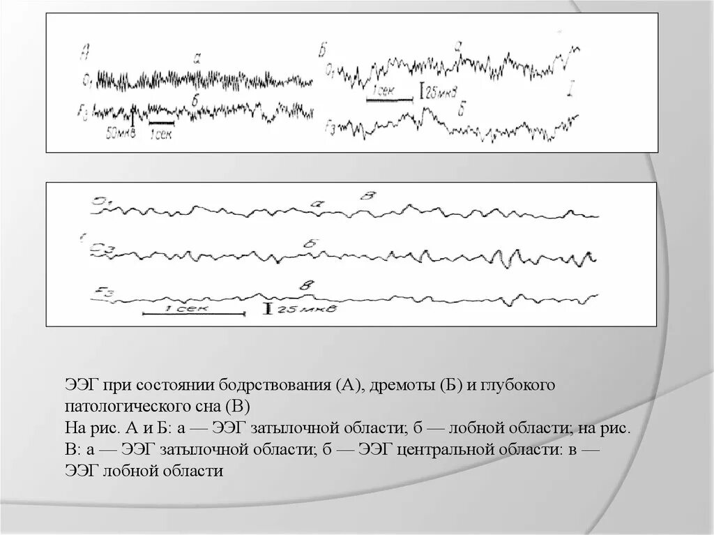 Ээг бодрствования. ЭЭГ норма бодрствовани. ЭЭГ сна дремоты. ЭЭГ сна и бодрствования. ЭЭГ при состоянии глубокого сна.
