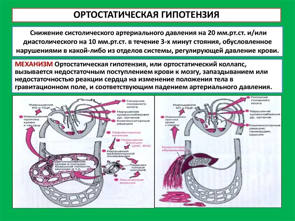 Механизм развития ортостатической гипотензии. Ортостатическая гипотензия патогенез. Артестатическая гипертензия. Клиническая картина ортостатической гипотензии.