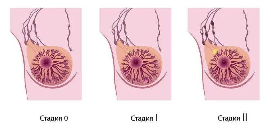 Стадии рака молочной железы. Стадии развития онкологии молочной железы. Опухоль молочного железа. Карцинома молочной железы 2 стадия.