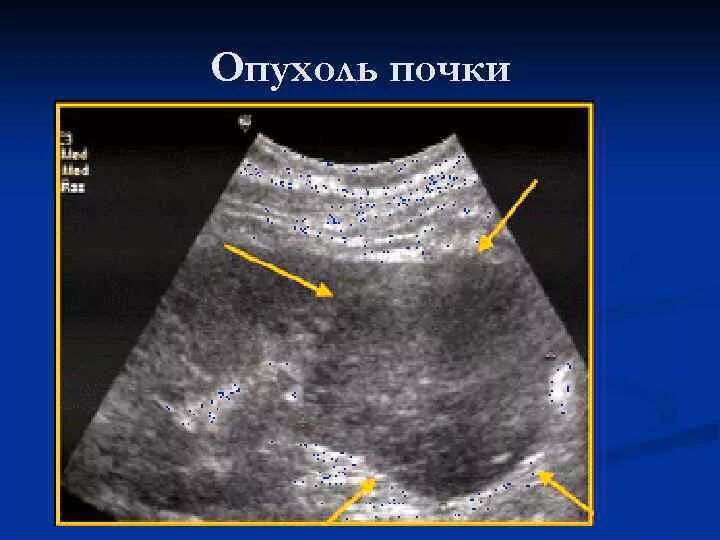 Новообразование в почке. Новообразования почки на УЗИ. Есть ли рак почки