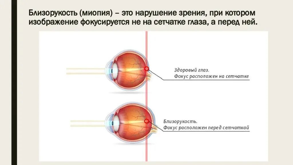 Близорукость хрусталик. Миопия зрения. Близорукость. Миопия. Близорукость отзывы форум.