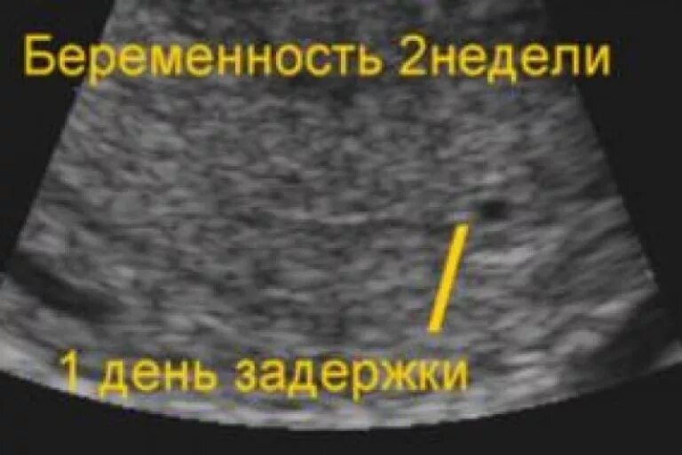 На узи можно определить раннюю беременность. Узи при беременности на ранних сроках. ультразвуковое узи при беременности на ранних сроках. маточная беременность на узи на раннем сроке.