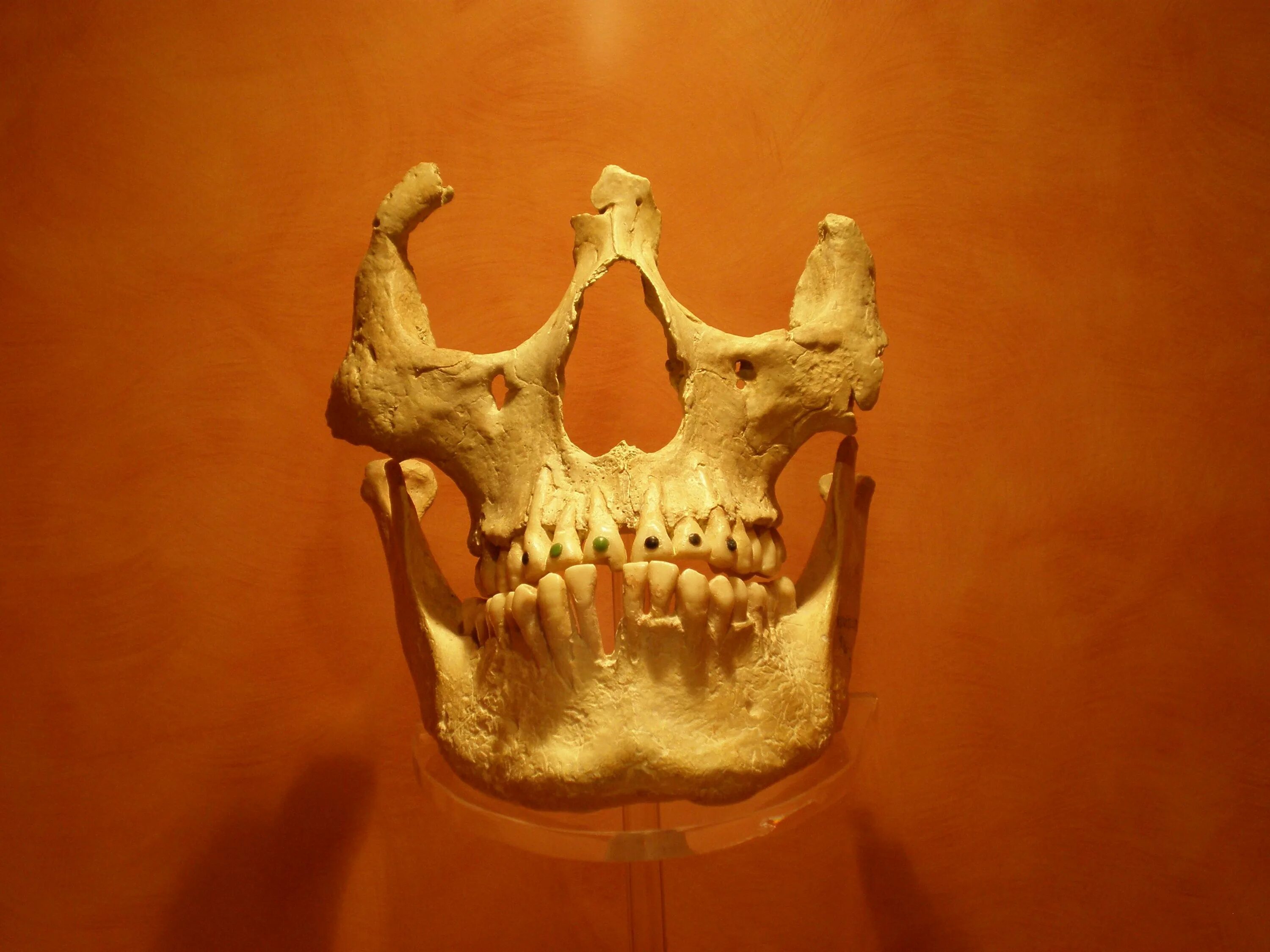 Зубные протезы в древности.