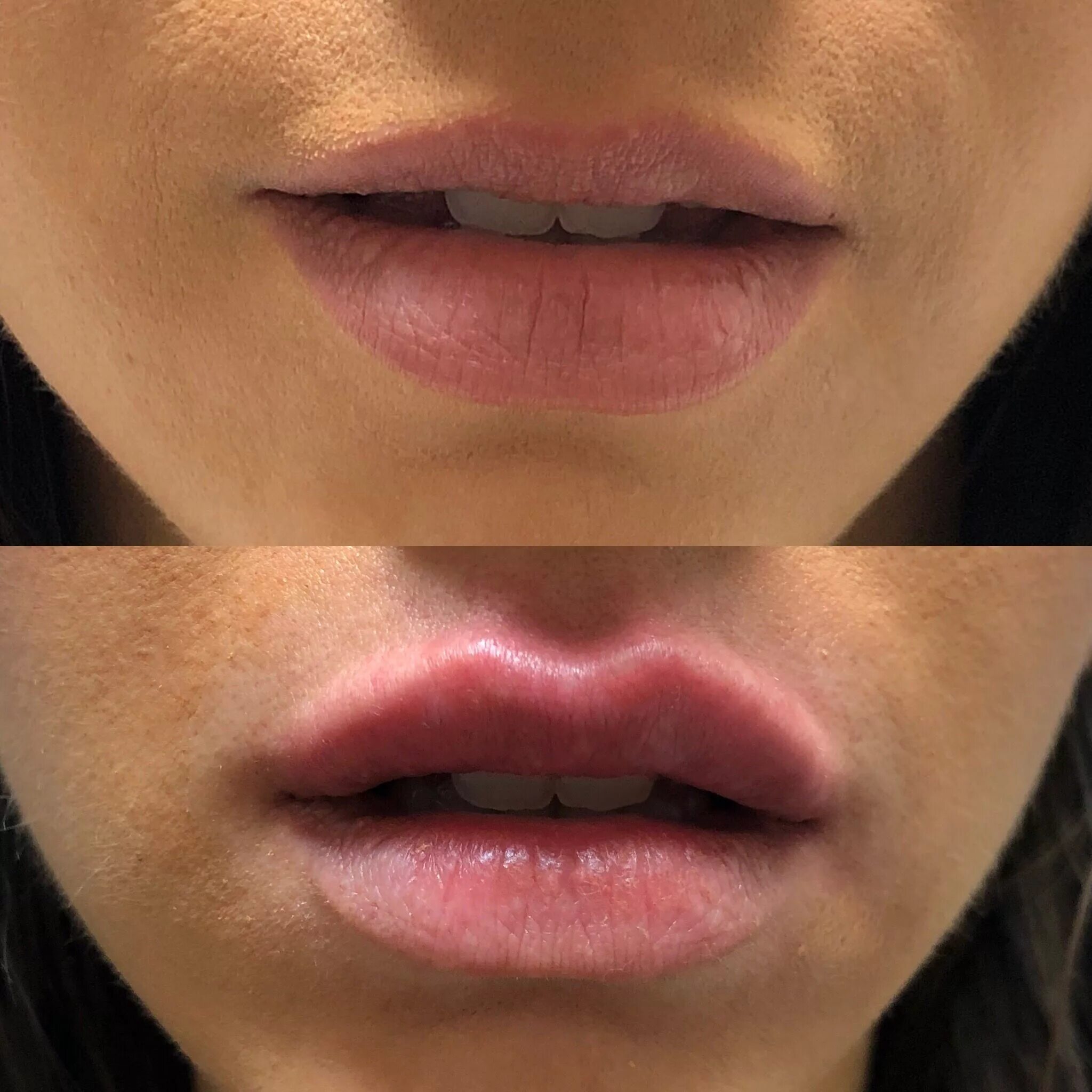 Увеличение губ lips