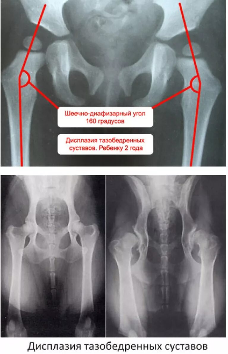 Дисплазия сустава у новорожденного лечение. Дисплазия тазобедренных суставов рентген. Дисплазия тазобедренных суставов у новорожденных 1б. Диагноз при дисплазии тазобедренных суставов у детей до года. Ацетабулярная дисплазия тазобедренных суставов.