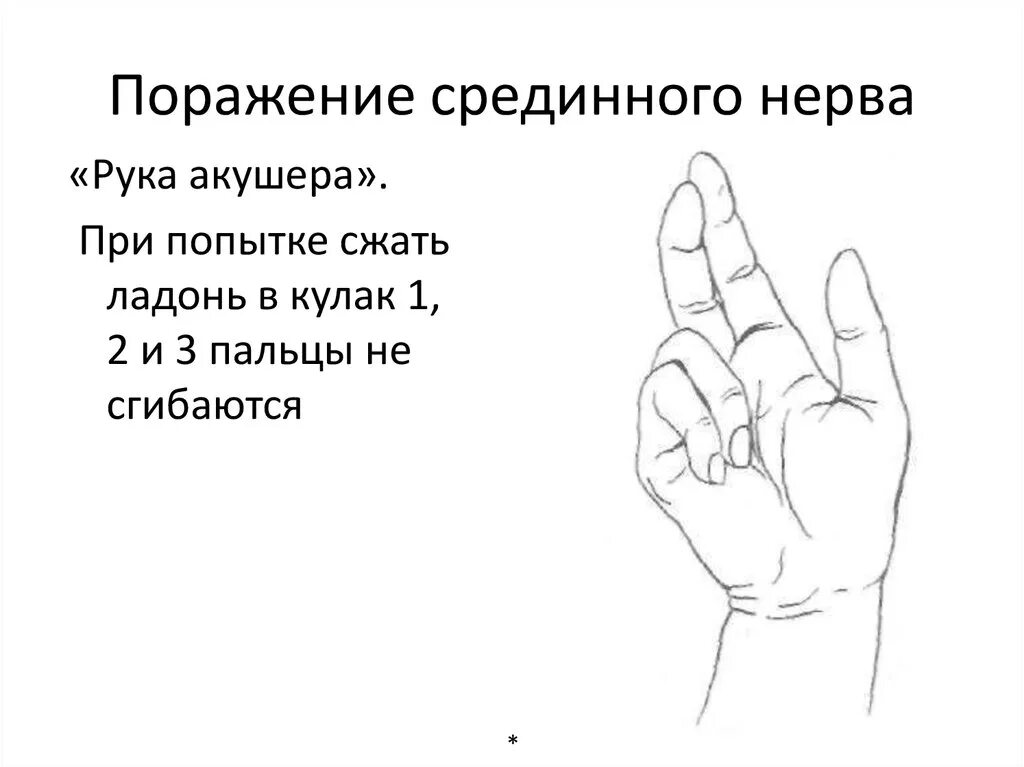 Поражение нервов руки. При поражении срединного нерва. Поражение серелинного нерва. Поражение срединного нерва руки. Рука акушера поражение срединного нерва.