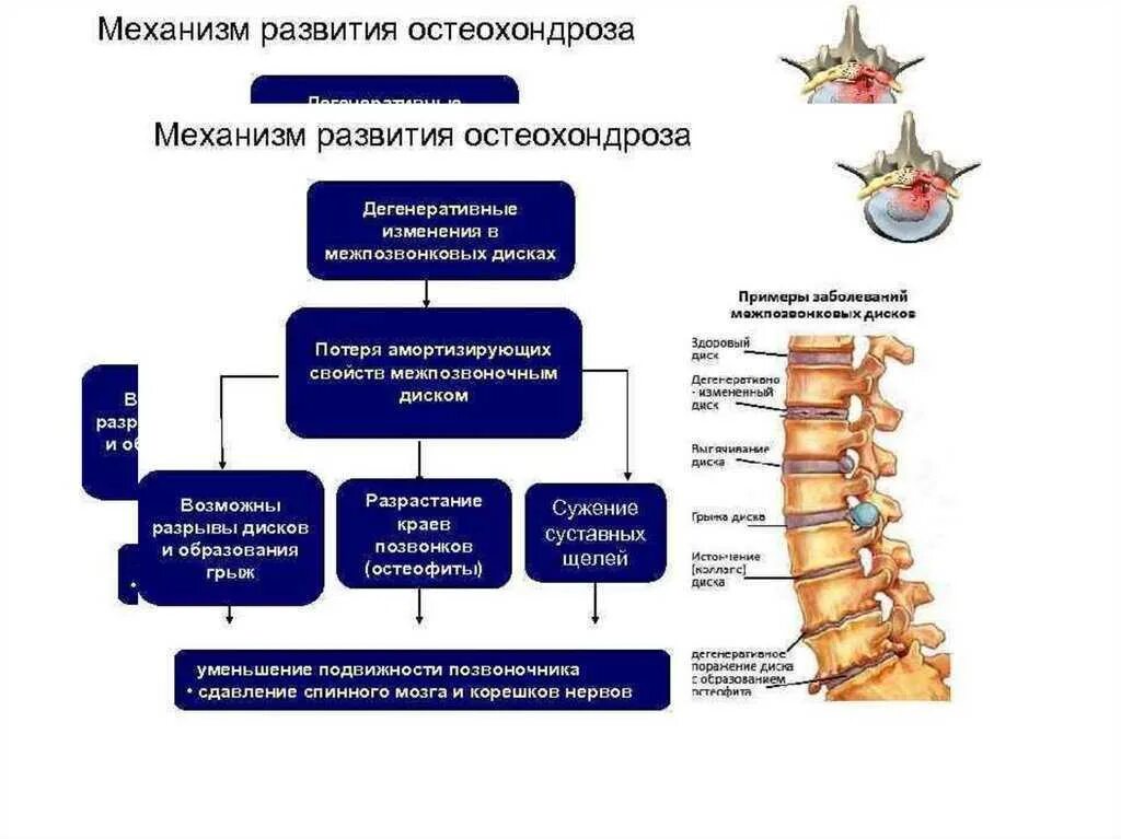 Дегенеративно дистрофические поражения. Дегенеративно-дистрофические заболевания суставов патогенез. Патогенез остеохондроза шейного отдела позвоночника. Патогенетические стадии остеохондроза позвоночника. Дегенеративно-дистрофические заболевания позвоночника.