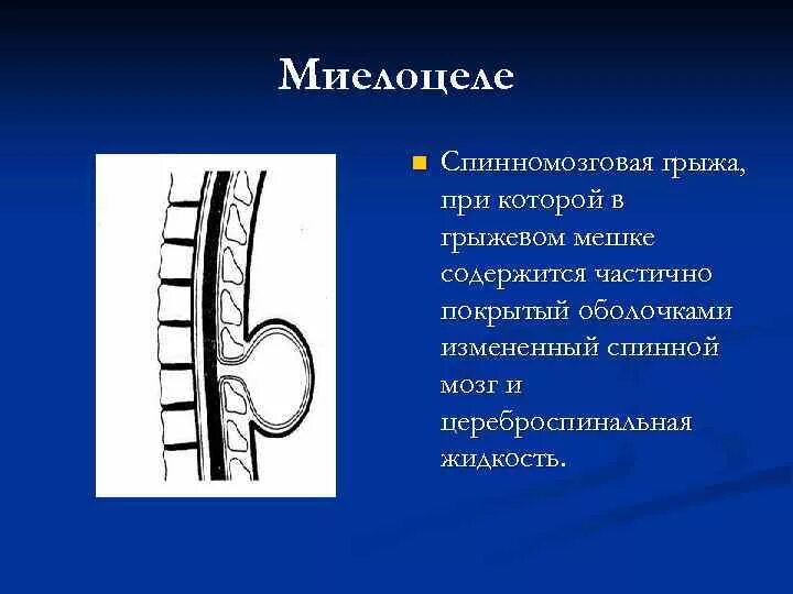 Грыжа мозговых оболочек освобождение нерва. Выпячивание оболочки спинного мозга. Спинномозговая грыжа менингоцеле.