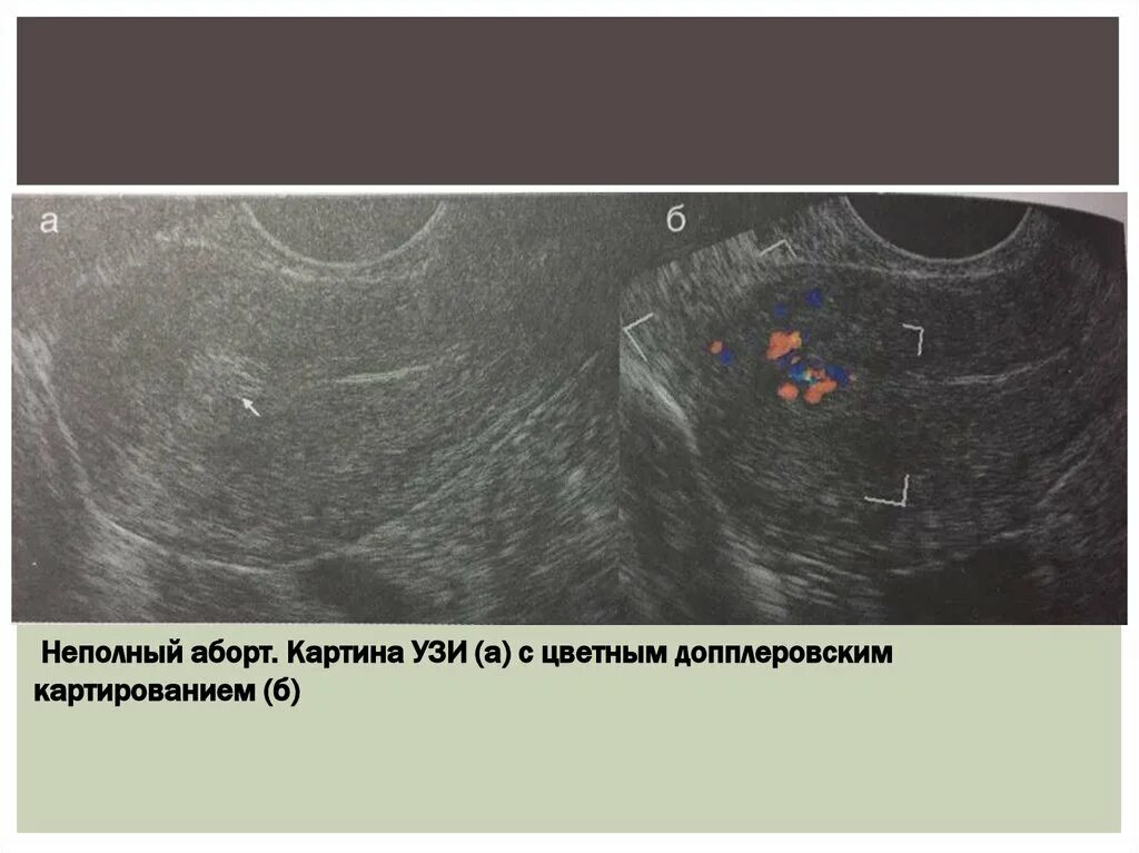 Матка после медикаментозного прерывания. УЗИ после медикаментозного прерывания беременности на 3 день. УЗИ после медикаментозного прерывания беременности норма. Неполный медикаментозный аборт на УЗИ.