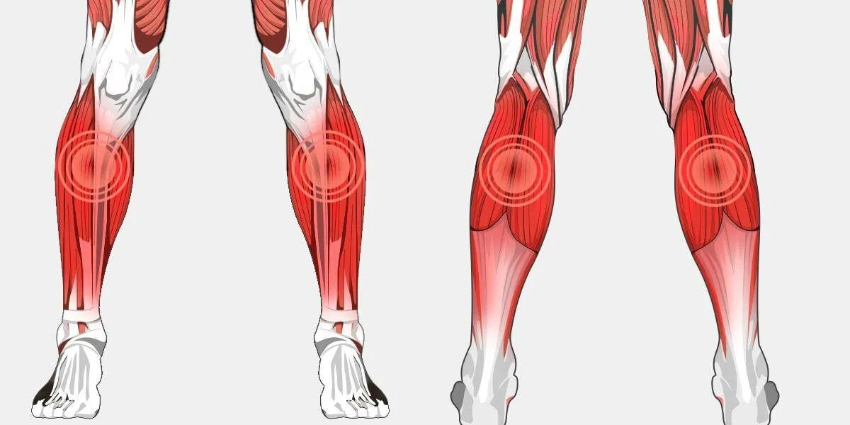 Сильно болят икры. Вены икроножной мышцы анатомия. Миозит камбаловидной мышцы голени. Ноги боль икроножная мышца. Варикоз икроножная мышца.