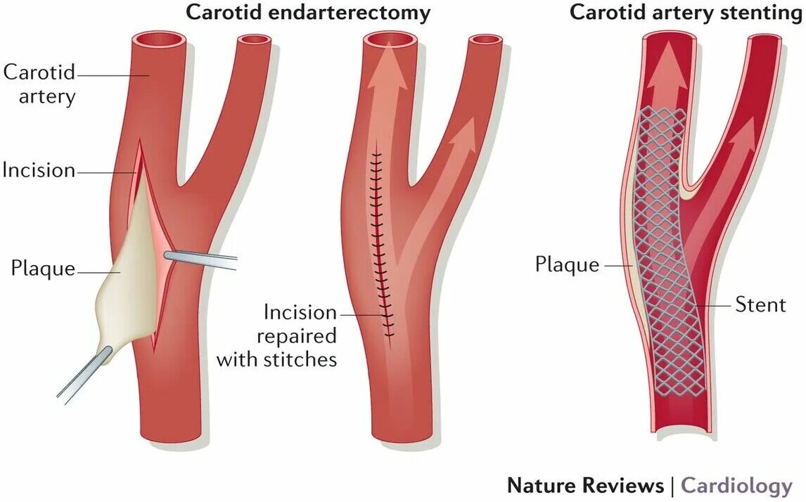 Операция каротидная эндартерэктомия. Каротидная эндартерэктомия сонной артерии. Каротидная эндартерэктомия классификация. Эверсионная каротидная эндартерэктомия