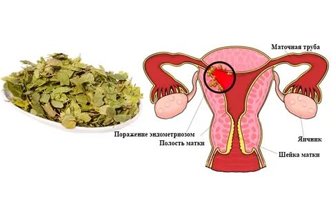 Информативная матка