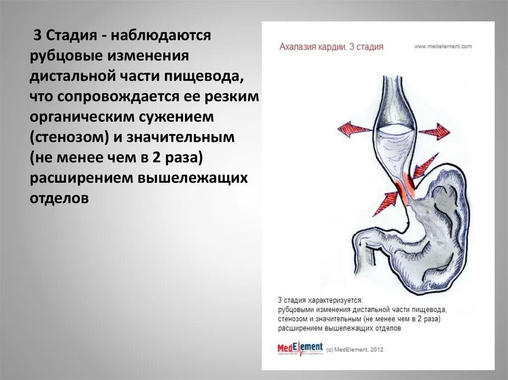 Недостаточность пищевода. Дистальная часть пищевода. Дистальный отдел пищевода,Кардия. Дистальной отдел птщевод. Дистальный отдел пищевода где находится.