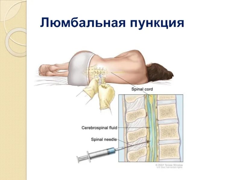 Жидкость в спинном канале. Люмбальная пункция манипуляция. Люмбальная пункция и спинномозговая пункция. Спинномозговая пункция топографическая анатомия.