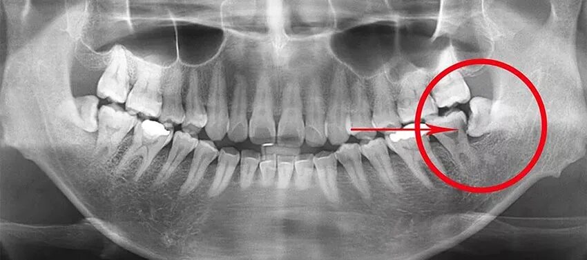 Зуб 8 нижний. Ретинированный зуб мудрости рентген. Ретинированный дистопированный зуб мудрости. Ретинированного дистопированного зуба мудрости. Ретинированный и дистопированный зуб по мкб 10.