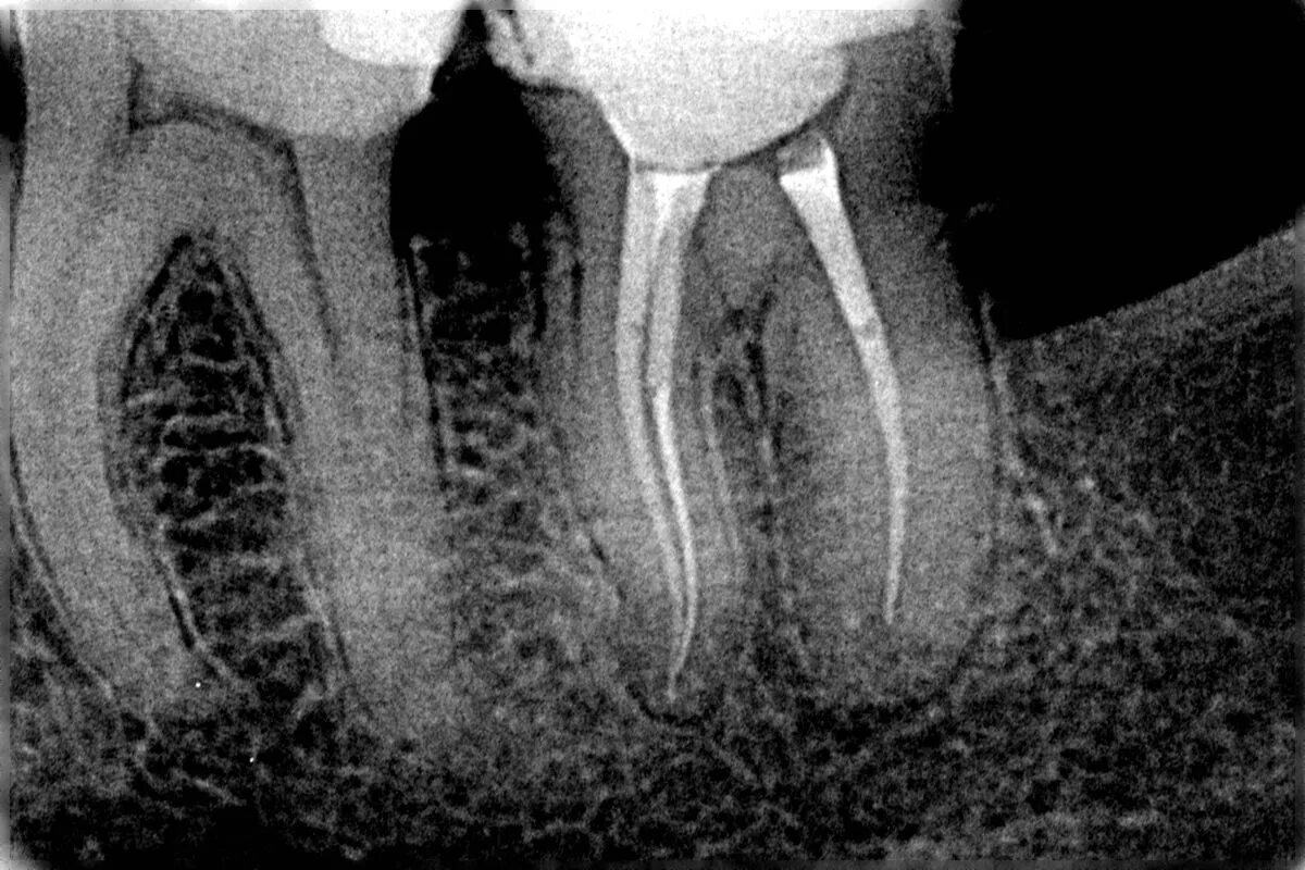 Восстановление после эндодонтического лечения. Периодонтит радиовизиография.
