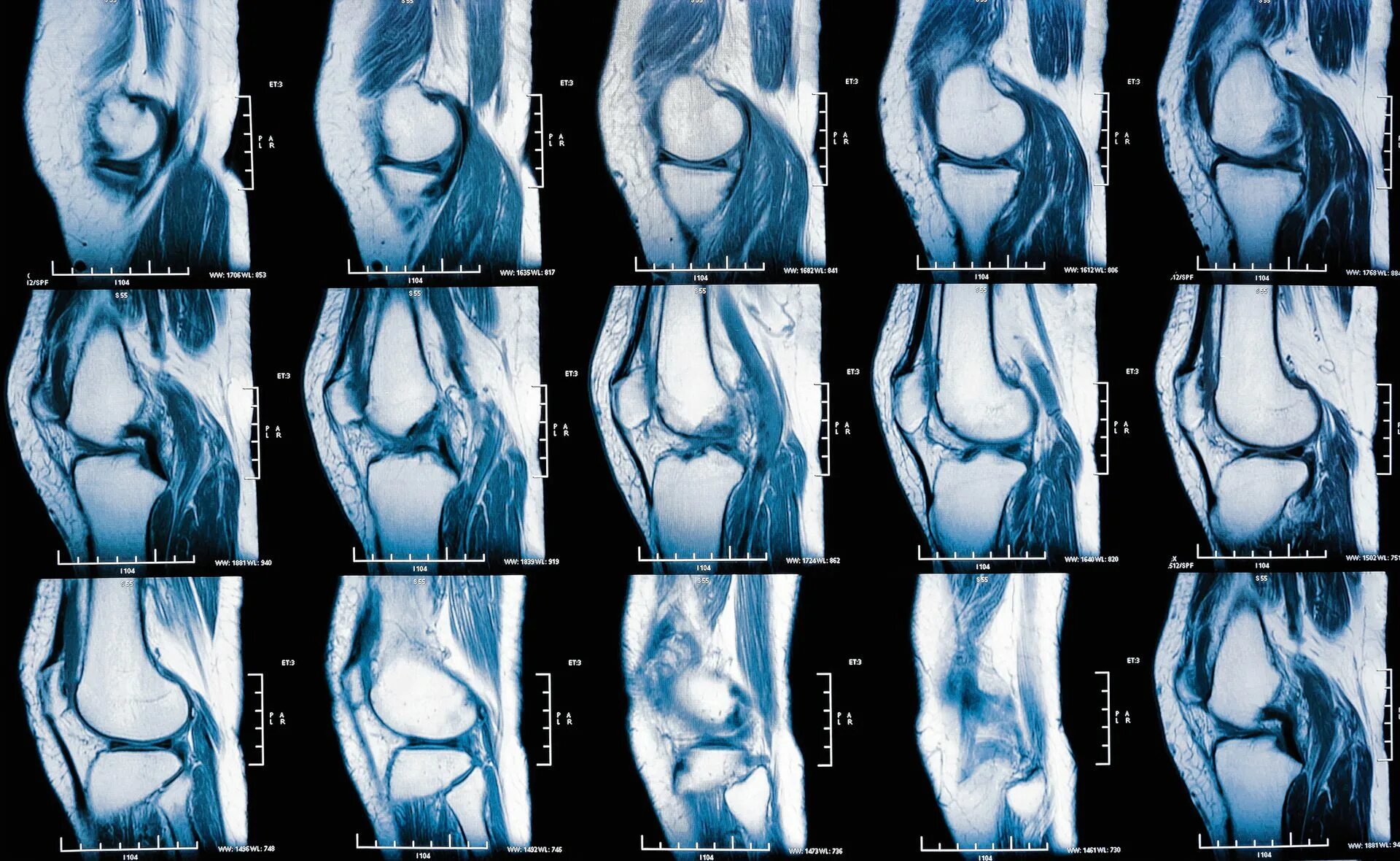 Разрыв мениска мрт. Снимок мрт коленного сустава с разрывом мениска. Снимок мрт разрыв мениска. Травма мениска коленного сустава мрт.