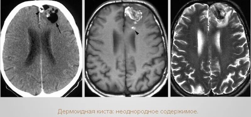 Кисты головного мозга на кт. Киста третьего желудочка головного мозга. Ретенционная киста головного мозга. Кисты головного мозга на кт. Киста головного мозга на кт.